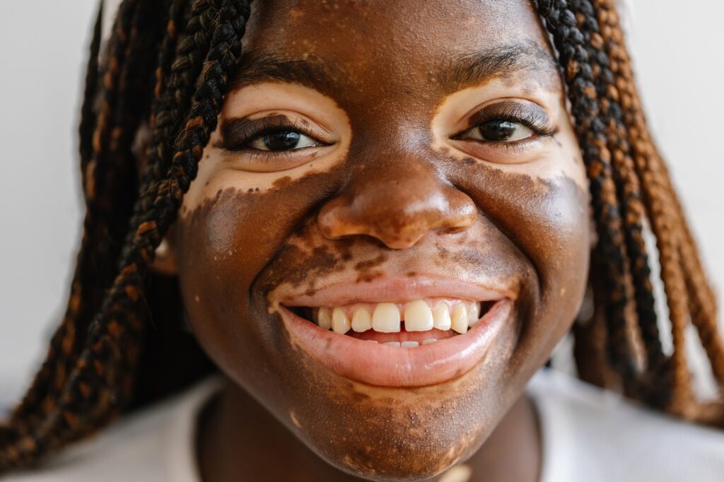 Close-up view portrait of young woman with vitiligo smile at camera
